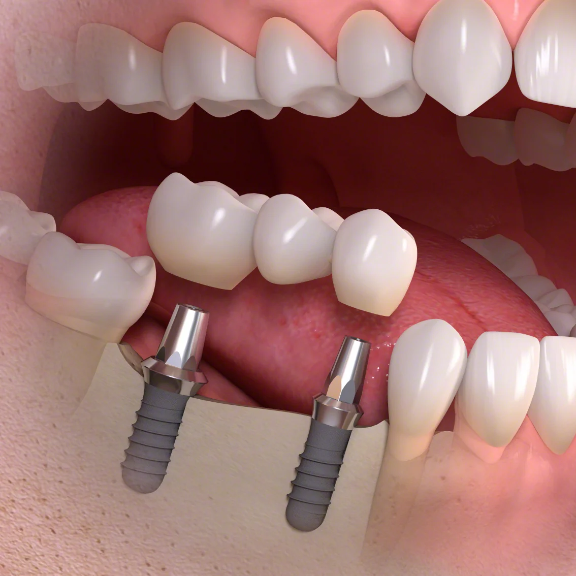 Schematische Darstellung: dreigliedrige Brücke über zwei Implantaten mit Aufbauten im Unterkiefer