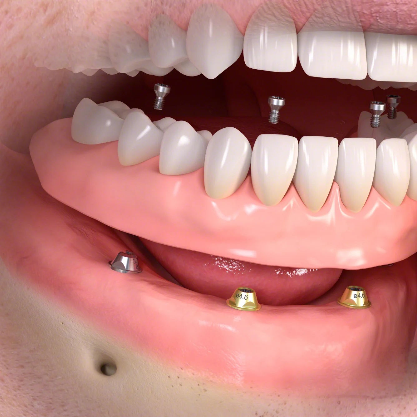 Schematische Darstellung: festsitzender Zahnersatz über vier Implantaten im zahnlosen Unterkiefer, mit Befestigungsschrauben