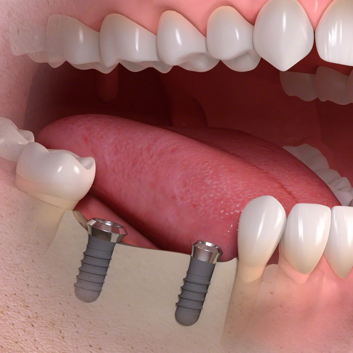 Schematische Darstellung: zwei im Unterkieferknochen verankerte Implantate als Träger einer Brücke